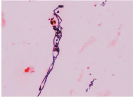 FIGURE 2. Microscopic appearance of C. albicans found in the sputum of patient, after Gram staining