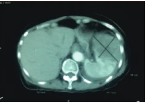 FIGURE 1. Abdominal CT scan before chemotherapy showing enlargement of spleen