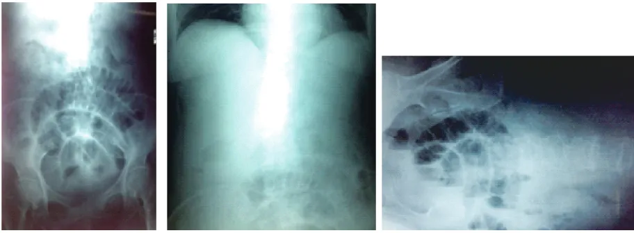 FIGURE 3. Abdominal x-rays showing signs of small bowel obstruction