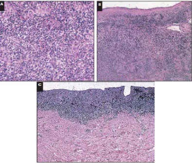 Gambar 2.2  Brisk tumor infiltrating lymphocytes. A, sebuah populasi padat dari limfosit pada sel melanoma maligna (Hematoxylin eosin, x200)