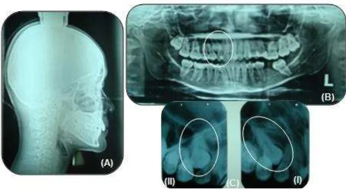 Gambar 3. Gambar 3.Radiograf sebelum perawatan (A) Sefalogram; (B)  Radiograf sebelum perawatan (A)  OPG, (C) Shift sketch