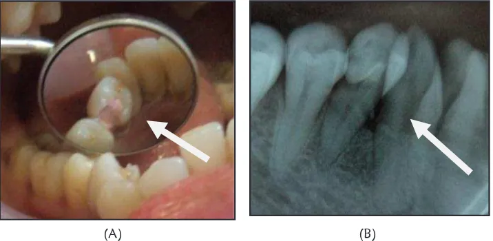 Gambar 1. (A) Foto klinis gigi 44 sebelum perawatan; (B) Foto rontgen sebelum perawatan