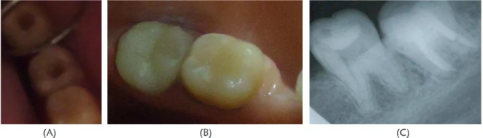 Gambar 7. Insersi pasak  (A) Gambaran klinis pasak utama pada distal dan pasak tambahan pada mesiobukal; A  A B (B) Gambaran  radiograf