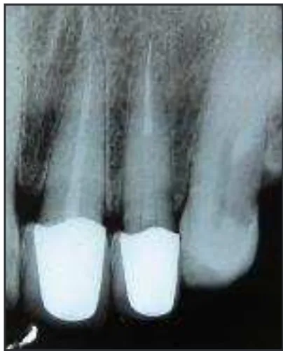 Gambar 6. Foto Radiograf setelah peraGambar 5. Foto Radiograf setelah pera-watan 6 bulan