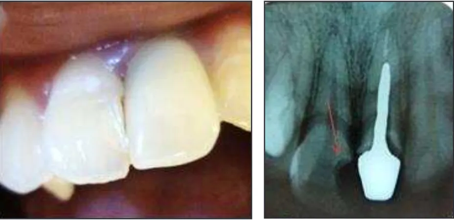 Gambar 1. Gambar 1. Gambar 1. Foto intraoral dan foto radiograf awal,  karies dengan kedalaman mencapai pulpa