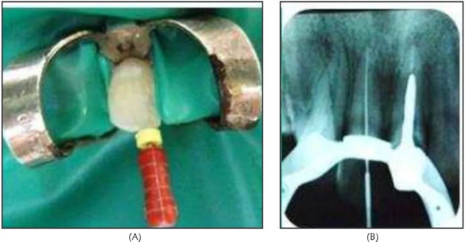 Gambar 2.Gambar 2.Gambar 2. Preparasi saluran akar (a) IAF; (b) radiograf pengukuran panjang kerja