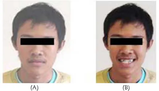 Gambar 1. Fotogram muka dan intra oral gigi-geligi sebelum perawatan kasus I Ket: (A) Fotogram muka tampak depan, (B)  Fotogram muka tampak depan  senyum