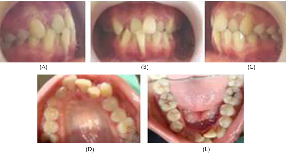 Gambar 3 . Fotogram mGambar 3. Fotogram muka  dan  intra oral  gigi-geligi  sebelum perawatan kasus II Ket: (A) Fotogram muka m muka dan intra oral tampak depan (B) Fotogram muka tampak depan senyum