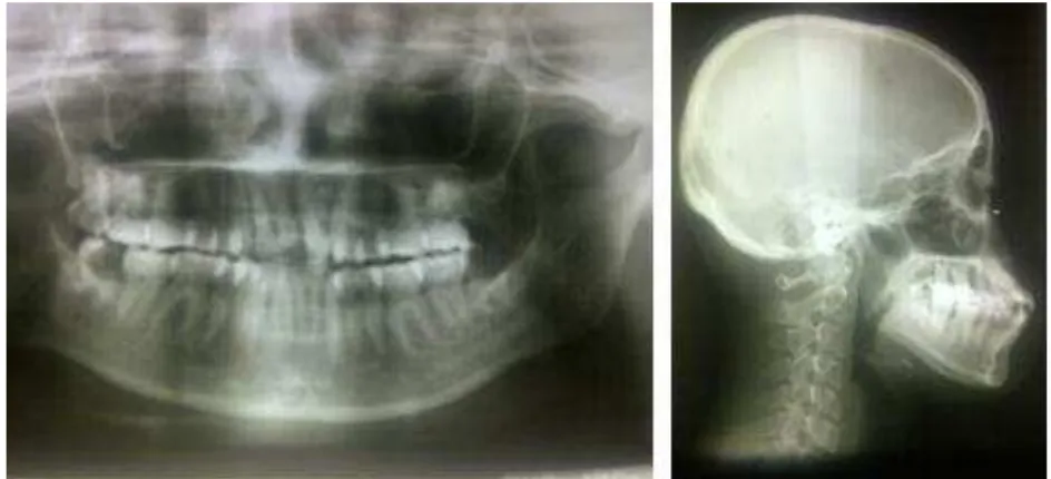 Gambar 3. Rontgen OPG dan sefalogram  sebelum perawatan ortodontik