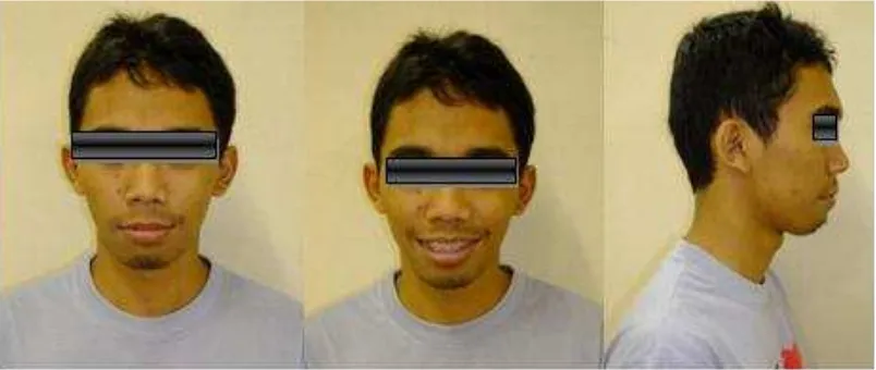 Gambar 2. Gambar 2. Foto muka setelah 16 bulan perawatan Foto muka setelah 16 bulan perawatan ortodontik