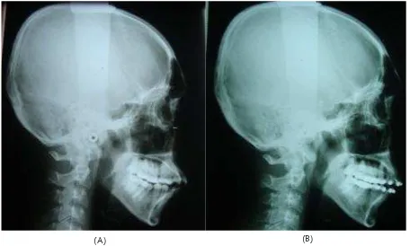 Gambar 4. Foto intra oral setelah 16 bulan Gambar 4. Foto intra oral setelah 16 bulan perawatan ortodontik.