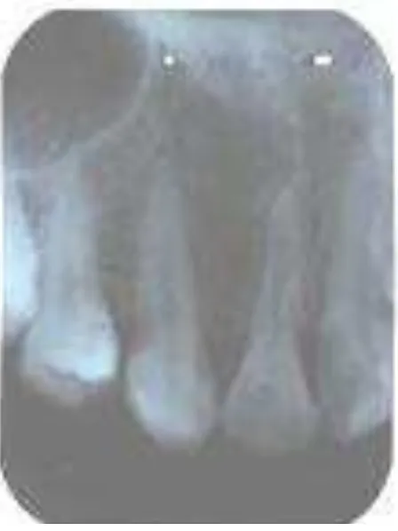 Gambar 8. Rontgen periapikal pada gigi 13 dan 12 setelah 1 tahun pemakaian retainer