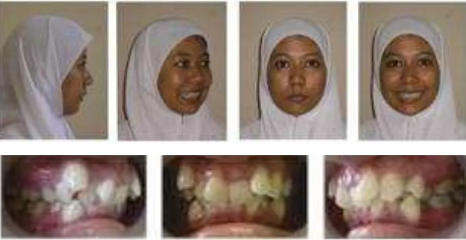 Gambar  1. Foto intraoral dan ekstra oral sebelum perawatan