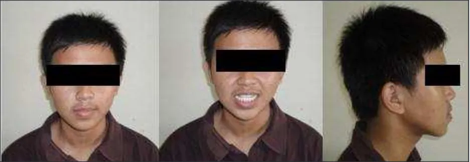 Gambar 1a. Foto ekstraoral sebelum perawatan Gambar 1. Foto ekstraoral sebelum perawatan