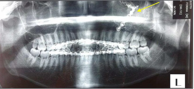 Gambar 10. Foto preoperasi (A) dan Foto pasca operasi hari ke 14 (B)  (A) daperlihatmemperlihatkan pipi kiri kembali prominen