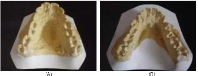 Gambar 3. Studi model  pasien sebelum perawatan, (A). bentuk lengkung gigi rahang atas V form asimetris; (B)