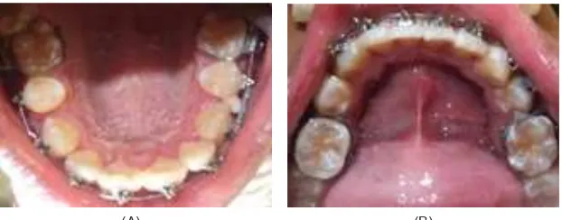Gambar 4. (A). Foto ekstra oral pasien setelah 7 bulan perawatan, (B). proil wajah pasien menjadi lebih baik.