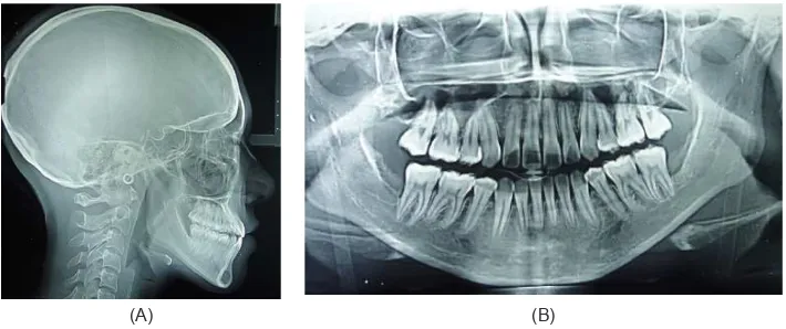 Gambar 3. Fotogram model studi gigi sebelum perawatan ortodontik :(A). Lengkung gigi rahang atas simetri; (B)