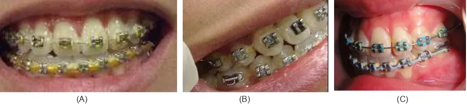 Gambar 7. Fotogram ekstra oral setelah perawatan ortodontik asimetri wajah terkoreksi ; (A).Tampak depan; (B).Tampak samping kanan; (C).Tampak samping kiri