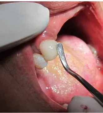 Gambar 2. Foto periapikal gigi 13 setelah perawatan saluran akar