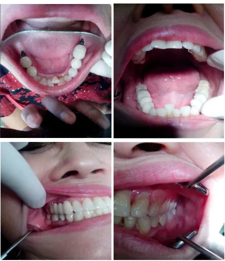 Gambar 7. (A) Mahkota sementara gigi 34, 35; (B) Mahkota sementara gigi 45, 46