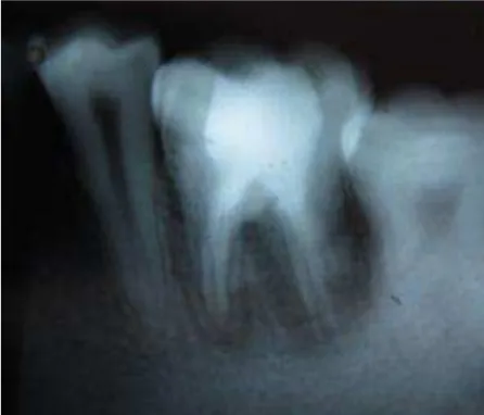 Gambar 4. Foto radiograis gigi 36, terlihat penyembuhan pada bifurkasi dan tulang alveolar bagian akar distal