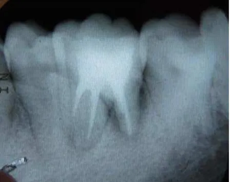 Gambar 5. Penyembuhan pada tulang alveolar sebelah akar distal gigi