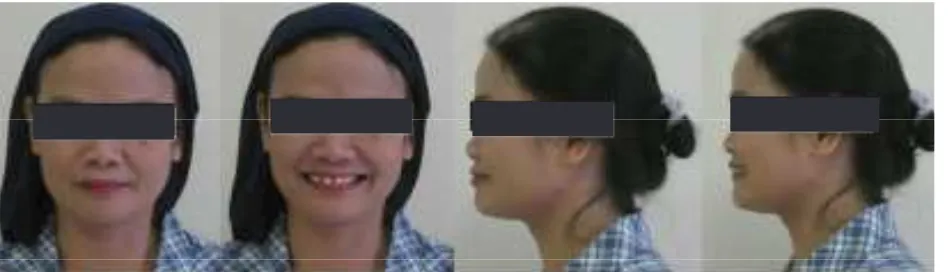 Gambar 1. Proil wajah pasien sebelum perawatan