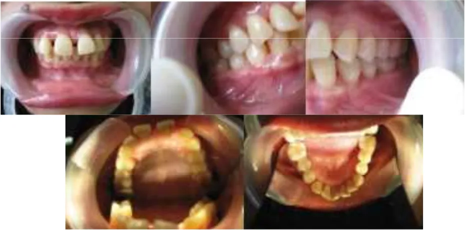 Gambar 2. Kondisi gigi geligi sebelum perawatan