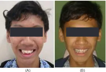 Gambar 1. Foto tampak depan sebelum (A) dan setelah 6 bulan perawatan (B)
