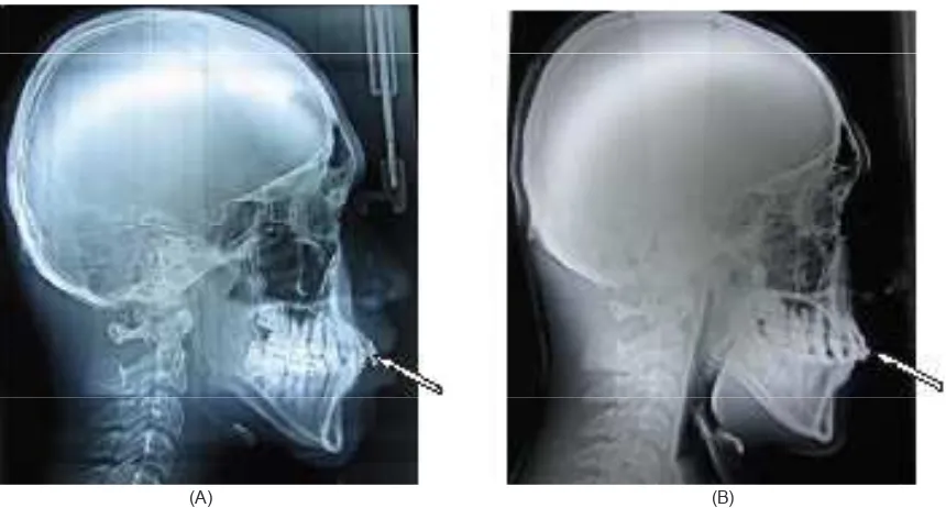 Gambar 3. Foto intra oral (A) sebelum dan (B) setelah 6 bulan perawatan 
