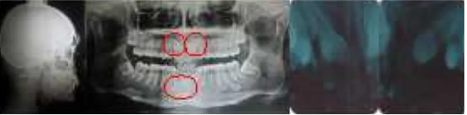 Gambar 3. Radiograi sebelum perawatan, gigi kaninus permanen kanan kiri atas dan kanan bawah impaksi
