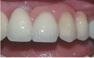 Gambar 3.  Gigi tiruan tetap pada kedua gigi insisiv sentral, insisiv lateral kiri dan kaninus kiri.3