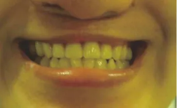 Gambar 16. Pasien dengan gigi tiruan overlay thermoplastic resin.