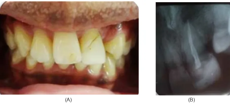 Gambar 1. (A) Keadaan klinis gigi 21;  (B) Radiograis gigi 21 tampak pengisian saluran akar tidak hermetis