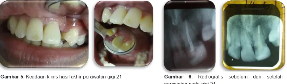 Gambar 5. Keadaan klinis hasil akhir perawatan gigi 21