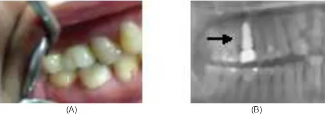 Gambar 2. (A) Evaluasi klinis setelah one piece-implant dipasang; (B) Gambaran radiograi setelah one-piece implant dipasang