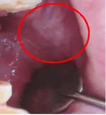 Gambar 4. Lesi traumatik berupa  sur dan erosif pada pada lateral lidah. (Dokumentasi pribadi)
