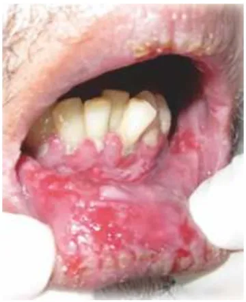 Gambar 2. Gambaran klinis lesi erosi pada pem gus (doc.RSHS/sub bagian IPM)  