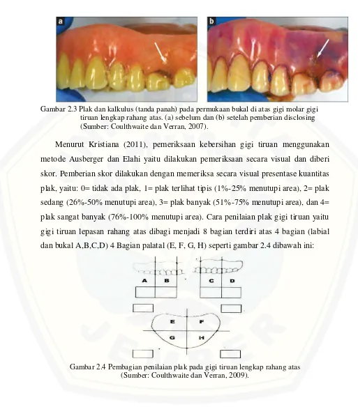 Gambar 2.3 Plak dan kalkulus (tanda panah) pada permukaan bukal di atas gigi molar gigi 
