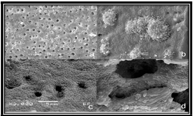 Gambar 2. Scanning electron microscopy (a) Beberapa permukaan saluran akar tertutup oleh     biofilm Enterococcus faecalis (x1500), (b) Permukaan saluran akar tertutup sempurna oleh biofilm Enterococcus faecalis (x3000), (c) Bukti bahwa seluruh permukaan tertutupi biofilm Enterococcus faecalis (x3000), (d) Bakteri berpenetrasi ke dalam  tubulus dentin (x5000).17  