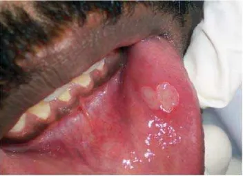 Gambar 2. Stomatitis aftosa rekuren tipe mayor28 