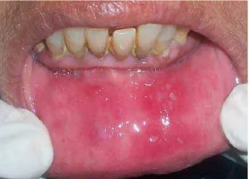 Gambar 3. Stomatitis aftosa rekuren tipe herpetiformis28 