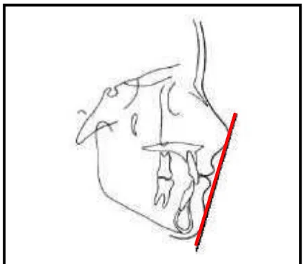 Gambar 4. Analisis jaringan lunak wajah menurut Ricketts (E line)20 