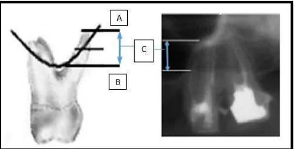 Gambar 8. Cara pengukuran jarak apikal gigi posterior 