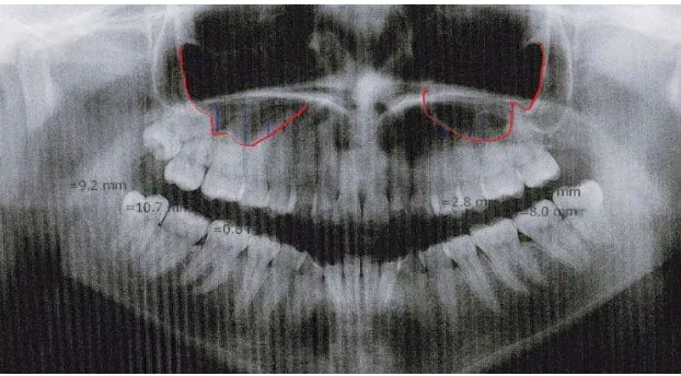 Gambar 9. Pengukuran jarak apikal akar gigi posterior     