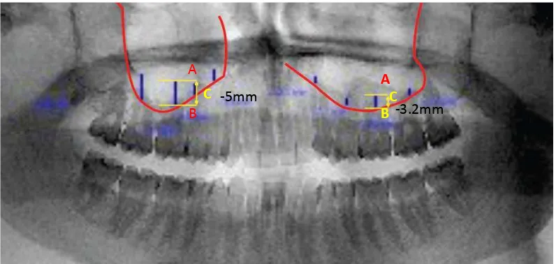 Tabel 2. Klasifikasi gigi P1 P2, M1 dan M2 pada regio kiri 