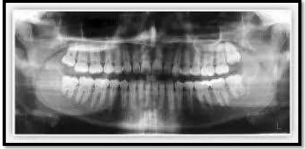 Gambar 7. Gambaran radiografi kerusakan tulang alveolar17 