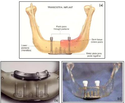 Gambar 2. Transosteal implant (a), (b), dan (c) Ilustrasi.32,34-5 