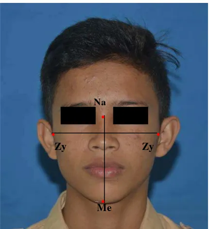 Gambar 15. Penentuan titik Facial Index 